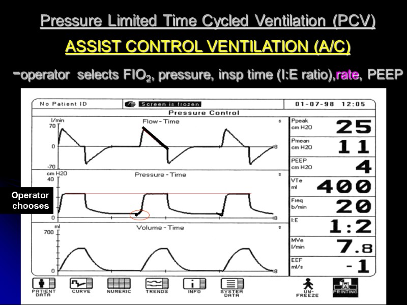 Pressure Limited Time Cycled Ventilation (PCV) ASSIST CONTROL VENTILATION (A/C)   -operator selects